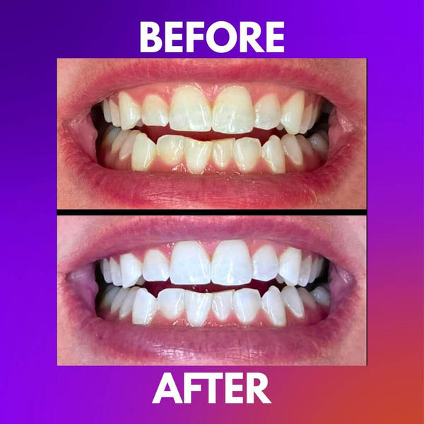 Pearl Fix Whitening Strips™