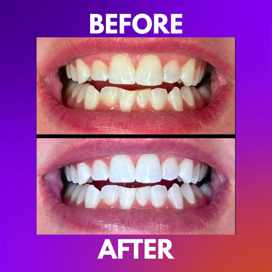 Pearl Fix Whitening Strips™
